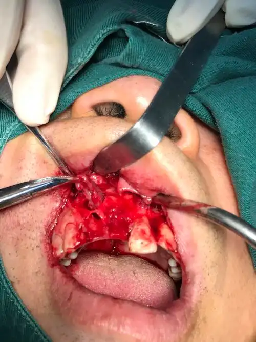 上颌骨囊肿及根尖囊肿摘除及上前牙拔除即刻种植分享 - 好大夫在线