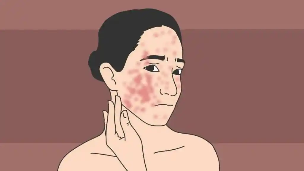 滥用激素对皮肤的危害,看完你还敢乱用激素吗?