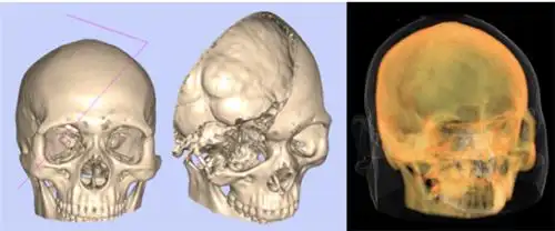 目前,领智三维已将医美整形三维重建技术推广到公立专科,公立综合整形