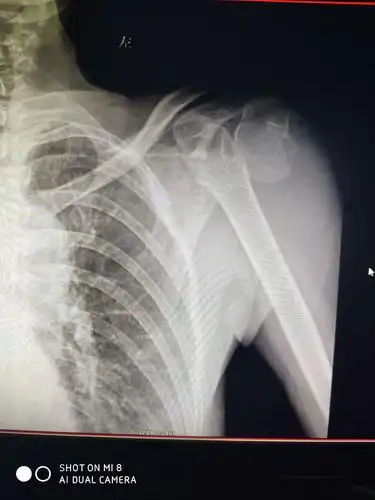 其它 浅色的夏末的美篇 写美篇患者余某,铁门镇人,以"左肱骨头粉碎性