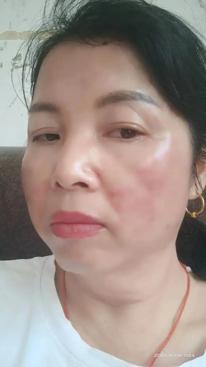 真实的脸,脸上疤痕的图片,又痒又疼,真的难受,友友们看见我的 - 抖音