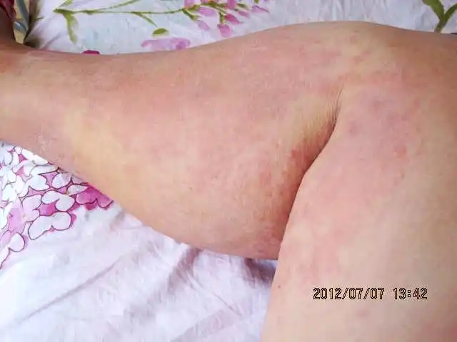 我是荨麻疹吗?多久能治愈?求助