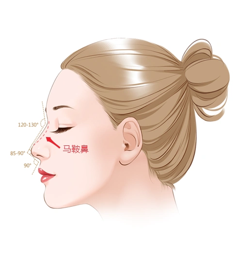 马鞍鼻综合矫正蜕变前后