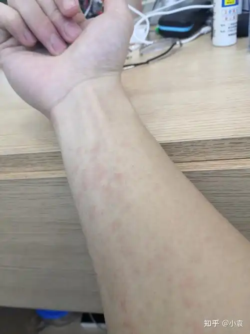 手臂长了一片红疙瘩