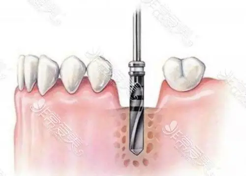 种植牙打桩步骤流程