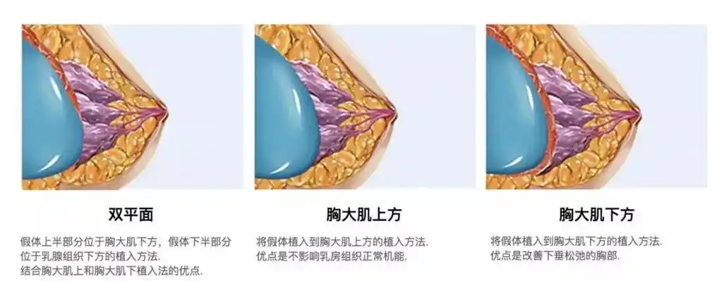 做假体隆胸手术是否安全?