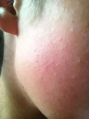 问:脸上好多小疙瘩怎么回事?要用药物吗?什么药物?