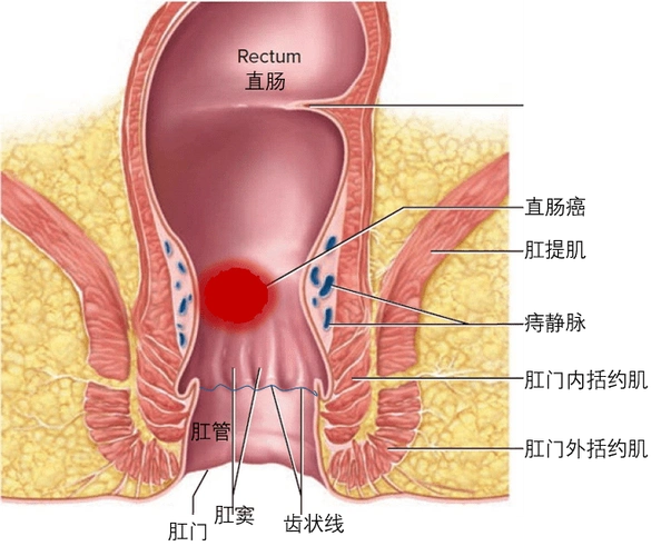 因"反复腹胀伴腹痛3个月"被查出直肠癌,肿块堵塞了直肠引起肠梗阻