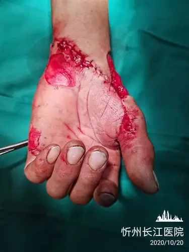 收割机绞伤致拇指掌侧毁损掌浅弓缺损一一忻州长江医院手外组