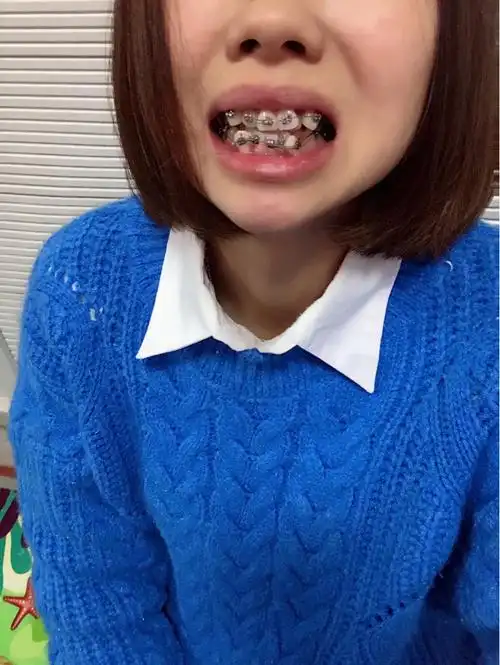 戴牙套的第三天