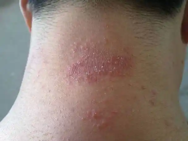 脖子上起了一片红疙瘩很痒是什么病