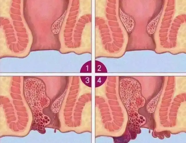 有痔疮的朋友注意,符合这种情况就是内痔_患者_症状_肛门