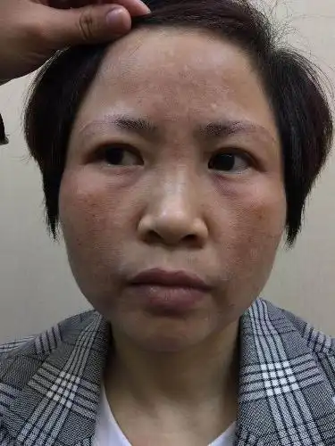 专业祛斑专做别人做不好的斑专做别人做坏了的斑专做别人不敢做的斑