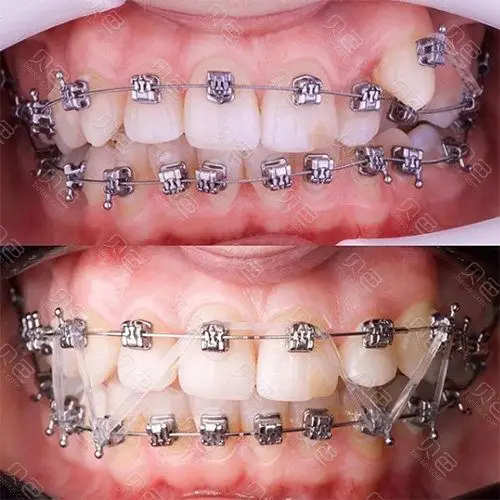 拔了会让嘴巴塌陷