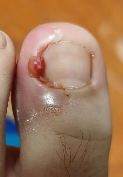 甲沟炎太痛了,化脓搞出肉芽在宿舍自己处理