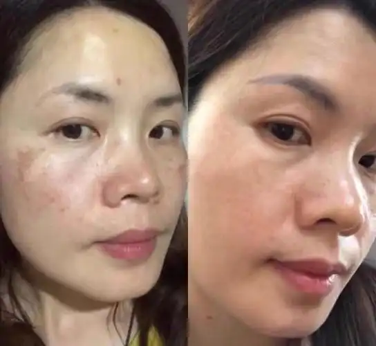 祛黄褐斑的偏方_祛黑祛黄_祛痘痘偏方