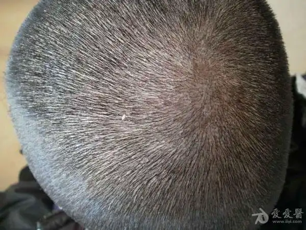 病例分享:头皮脂溢性皮炎.