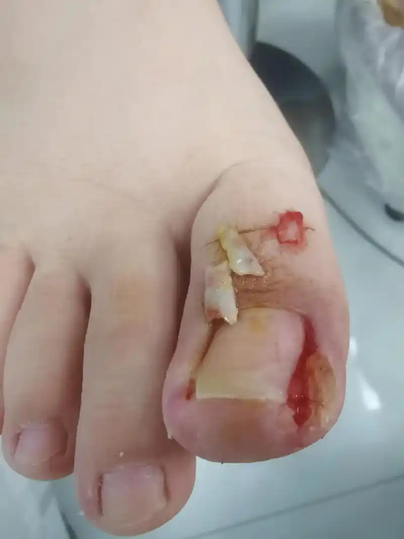 周末是学生挖甲沟炎的日子,孩子们脚趾甲疼我心疼! - 抖音