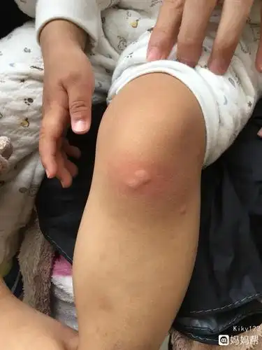 合法!新生儿荨麻疹症状"而立之年"-第1张图片-酷虎博客