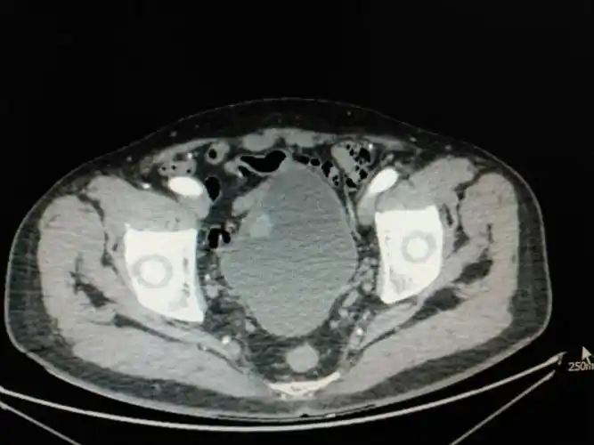 "针状电极t2期膀胱肿瘤剜除术"一例分享——术者:兰大二院尚攀峰