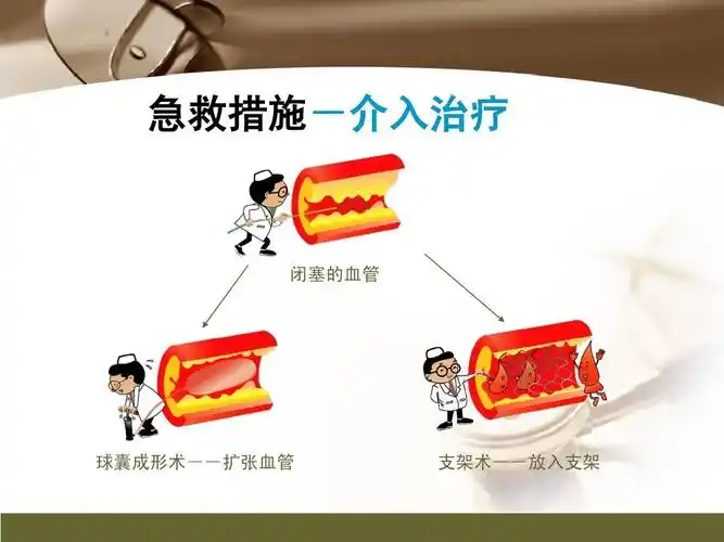 心肌梗死的健康宣教 急救措施-介入治疗 闭塞的血管 球囊成形术--扩张