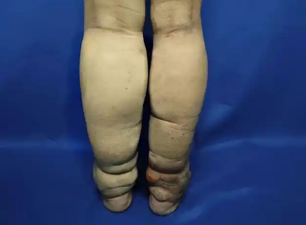 肿成大象腿台州母女双双确诊