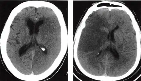 [经典总结] "急性期脑梗死"的影像学特点及几个重要征象(建议收藏)