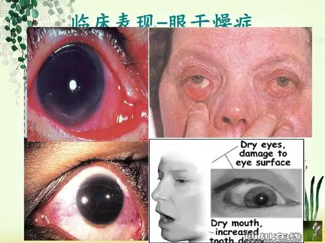 干燥综合症护理ppt
