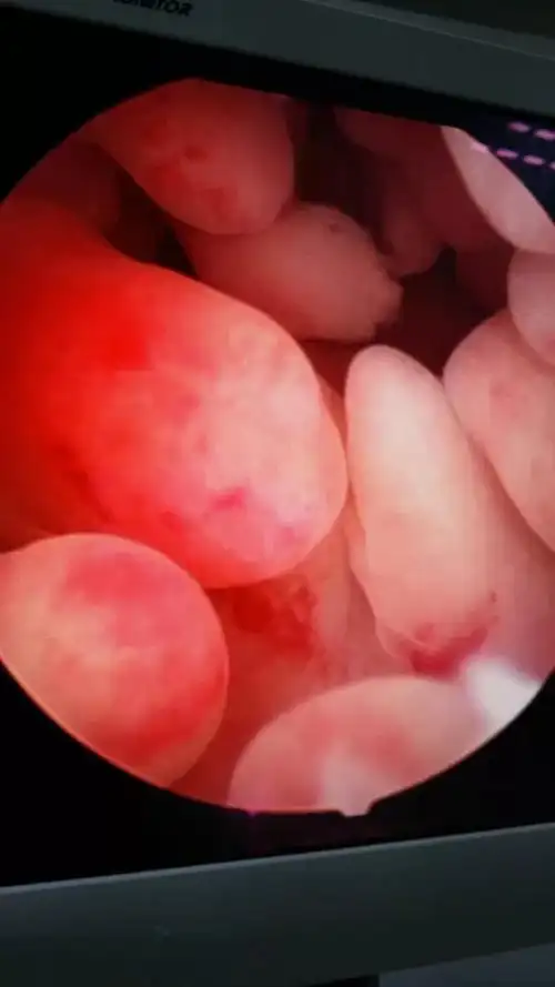 caption子宫内膜息肉是一种非常常见的妇科疾病.