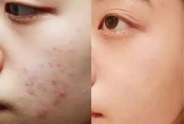 祛痘神器!纯天然蜂胶,万能修复,不留痘印