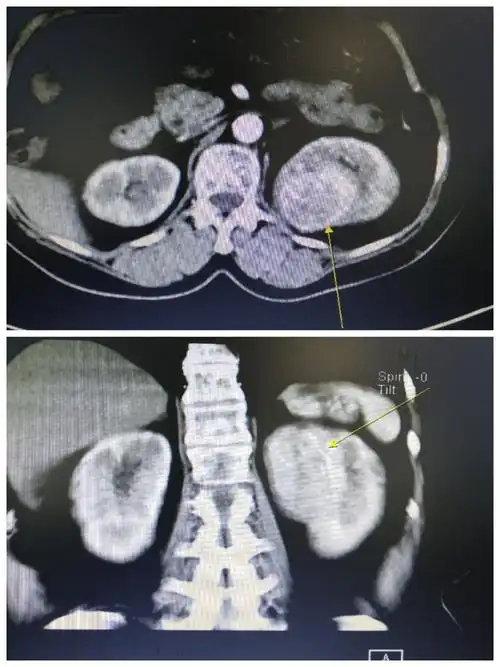 汉寿县人民医院泌尿外科成功进行一例腹腔镜下左肾癌根治术