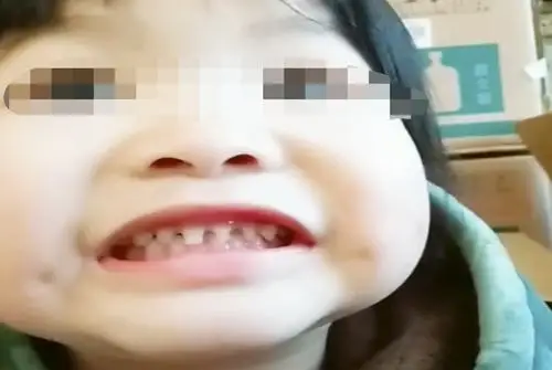 2岁宝宝长出"鲨鱼牙",妈妈慌忙带娃就医,医生:夜奶惹的祸