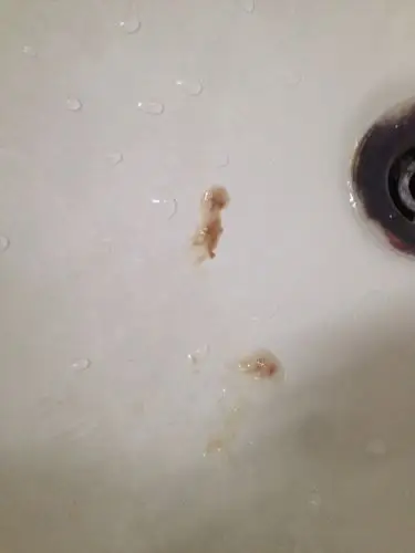 早上起莫名其妙吐这种痰请问怎么回事上