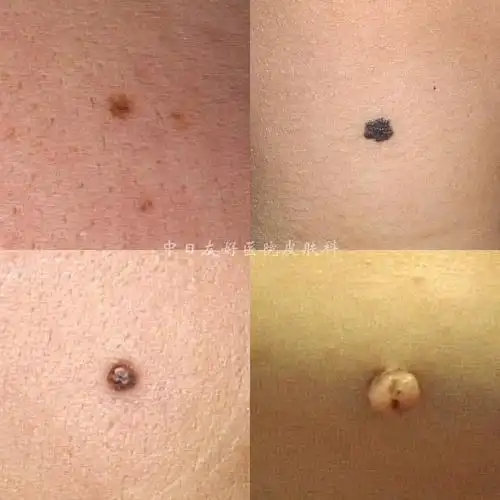 小小色素痣,需要就医吗?