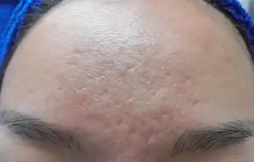 如何去除"痘坑,痘疤"