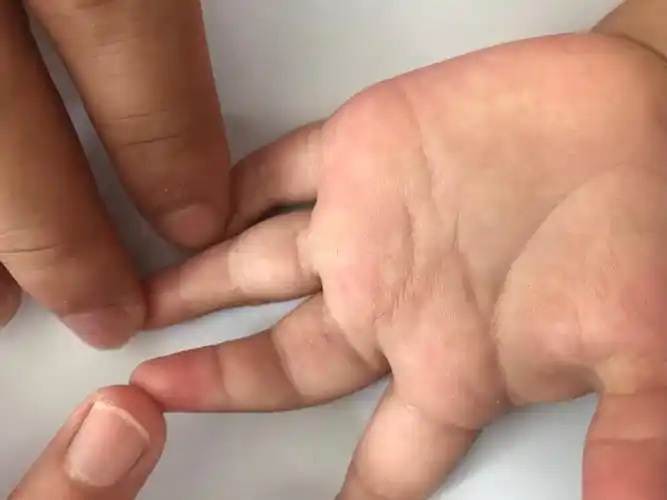 会诊病例:孩子手指伸不直,五个月前曾经在上级医院手术一次,效果不