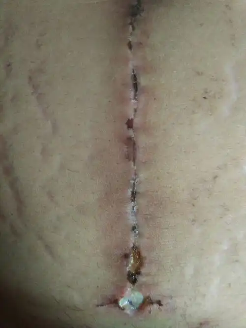 夏天做破腹产的伤口化脓了,怎么办?不去医院也可以治疗吗?