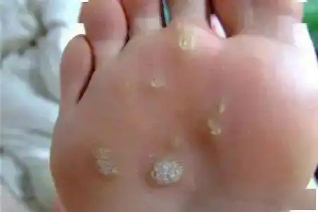 疾病预防想没疣烦恼这些知识一定记牢