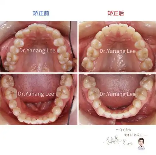 【前牙对刃 侧切牙反颌矫正案例】