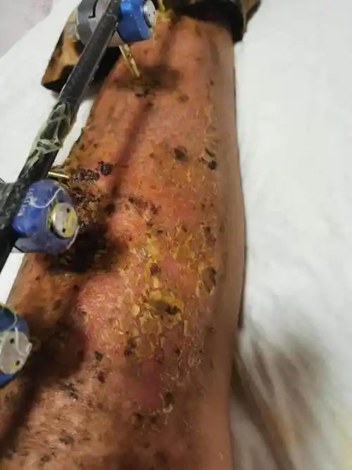 双下肢汽油桶爆炸伤治疗的前后经过