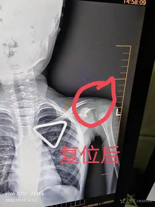 儿童锁骨远端骨折保守治疗