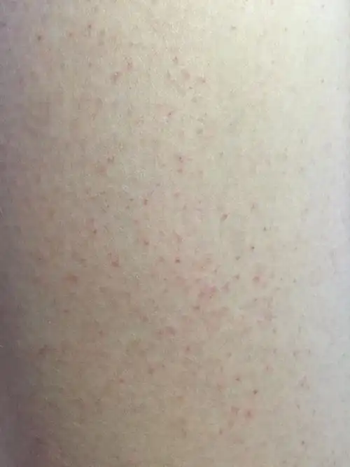 身上长小红点,医生说是过敏,吃了药感觉更严重了怎么回事?