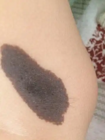 医生你好小孩子脚上有一块黑色的胎记,请问需要治疗吗