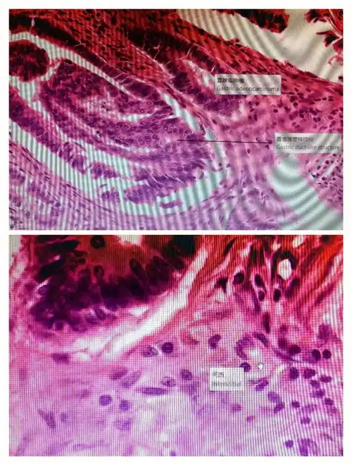 实验五病理组织切片观察五肿瘤