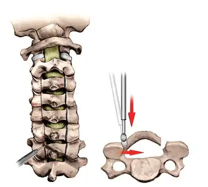 第二步:对侧椎板磨开一半作为铰链侧.