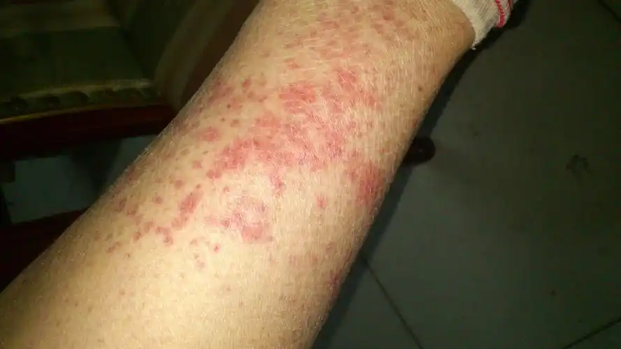 你血压是否正常,看上去像毛细血管破裂 来自:求助得到的回答 |评论