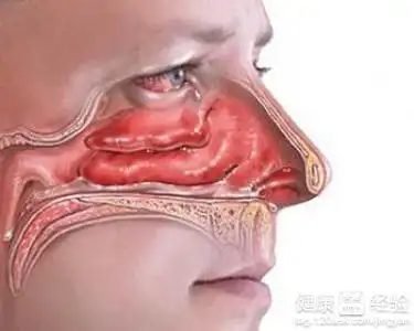 双侧下鼻甲肥大的简介