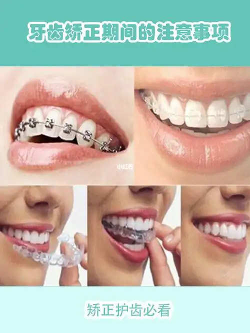 牙齿矫正期间的四大注意事项