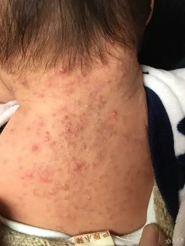 几个月患儿病历