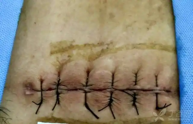 第四步 二期缝合观察两天后出院,回到当地拆线,患者拍照发给我(患者很